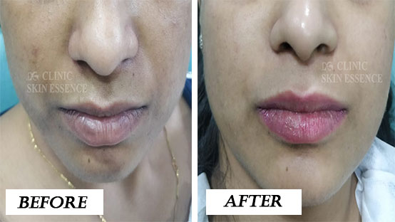 Pigmentation Treatment Before and After Image