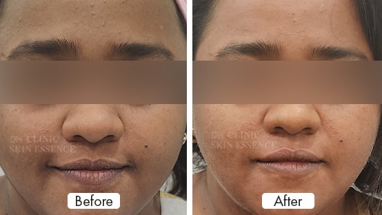 Pigmentation