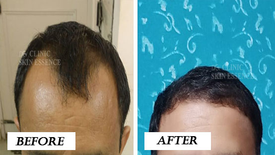 Hair Transplant Before and After