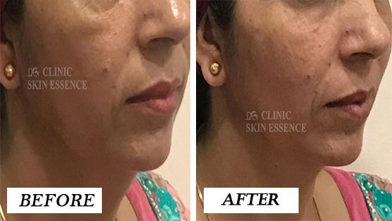 Dermal Fillers Before and After