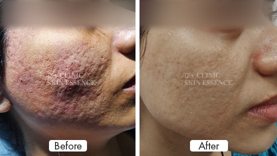 Acne Scar Reduction