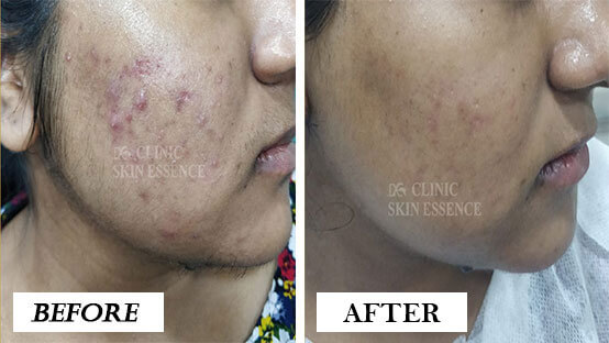 Before and After Acne Treatment