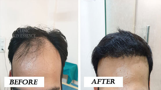 Hair Transplant Before and After