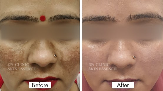 Melasma