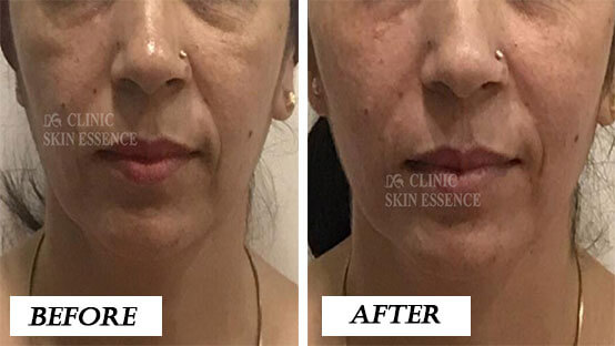 Dermal Fillers Before and After