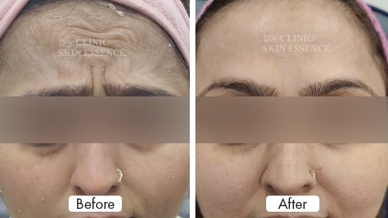 Anti Wrinkle Injections