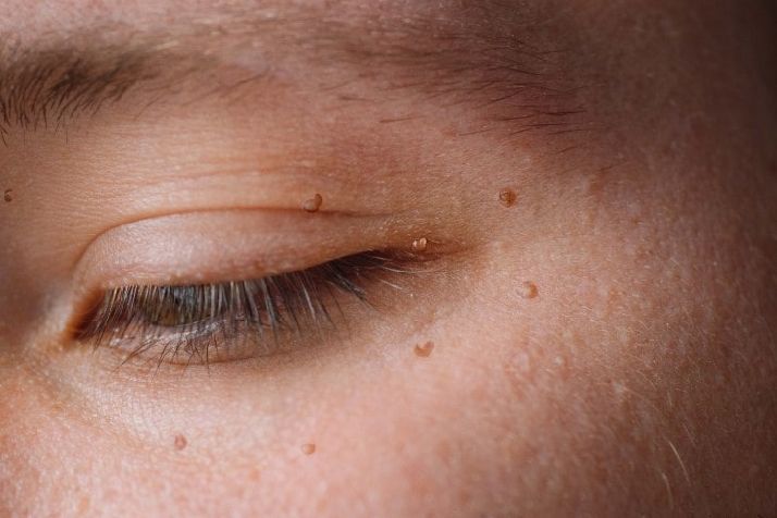Warts Removal Treatment in Delhi