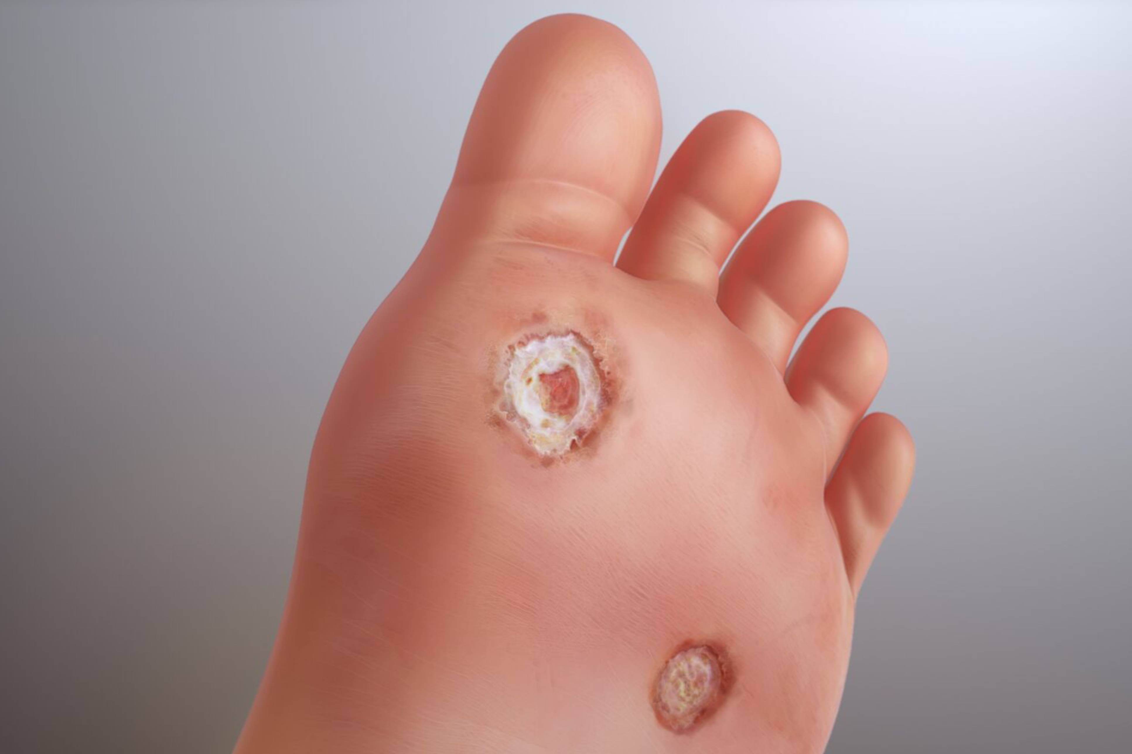 Wart Treatment in Delhi
